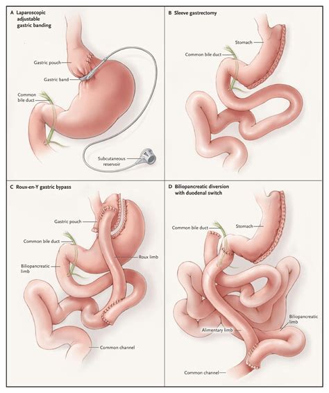 Bariatric Surgery for Morbid Obesity | New England Journal of Medicine