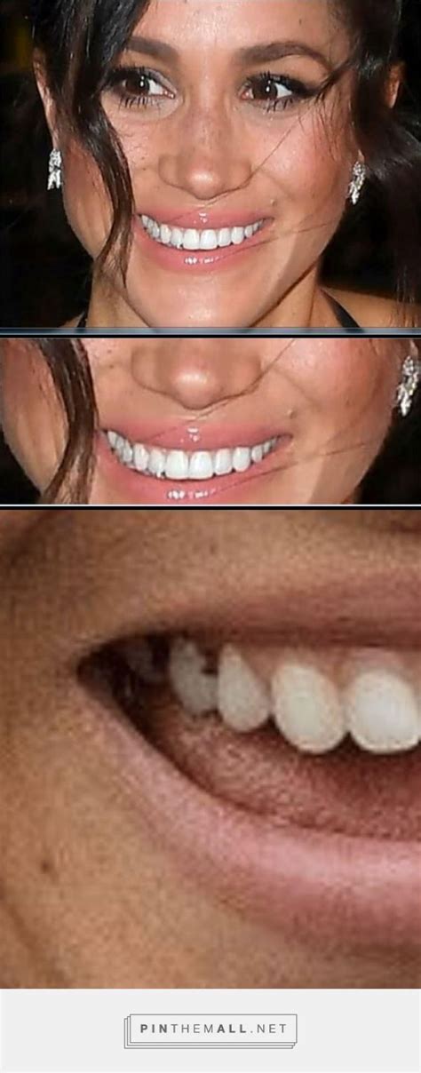 Meghan Markle;s back teeth have the same problem. She covers up her ...