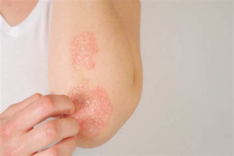 Plaque Psoriasis: Causes, Triggers, Symptoms & Treatments