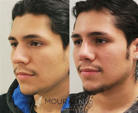 Male Rhinoplasty Before and After | Facial Plastic Surgeon