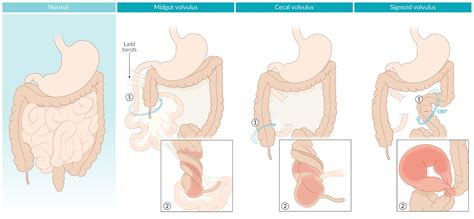 Cecal Vs Sigmoid Volvulus - Mari-Kiketi