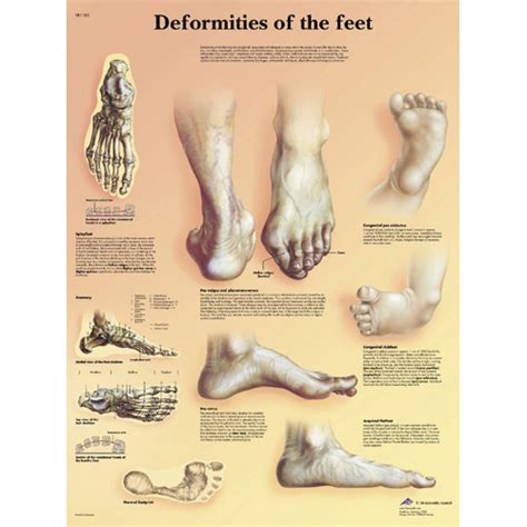 Foot Deformities