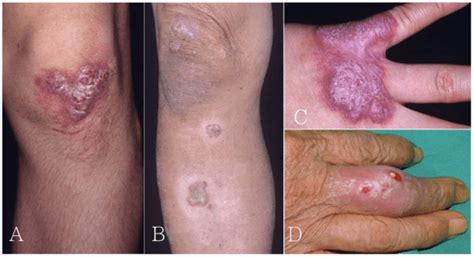 Table 1 from Fish Tank Granuloma Caused by Mycobacterium marinum ...