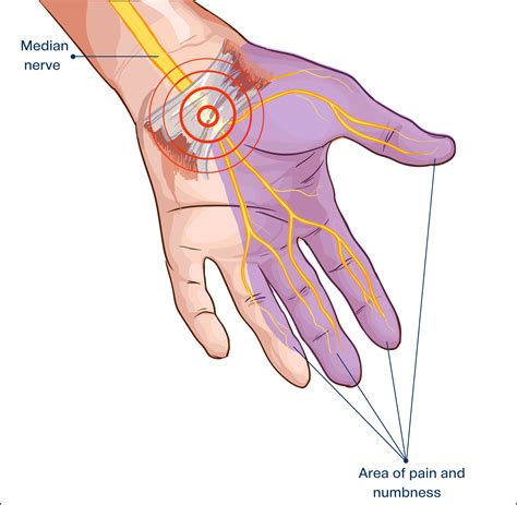 Hand and wrist - Orthopaedic Center of the Virginias