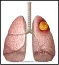 Lung Abscess-Treatment-Causes-Signs and Symptoms
