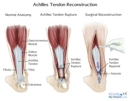 Achilles tendon repair - Physiopedia