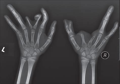 DEFORMED FINGERS 8 | buyxraysonline