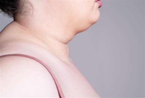 Exercises, Diet & Posture to Get Rid of Neck Fat - eMediHealth