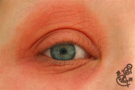 How To Treat Red Swollen Eyes From Allergies - Heal Info
