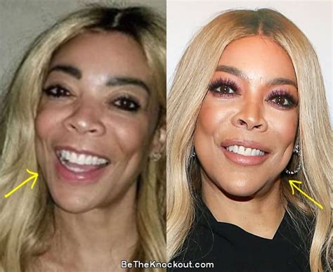 Wendy Williams Plastic Surgery Comparison Photos