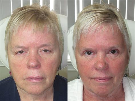 Before and After Ptosis Repair and Eyelid Retraction Surgery Photos - Boston Eyelids
