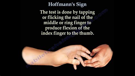 Hoffmann's Sign - Everything You Need To Know - Dr. Nabil Ebraheim ...