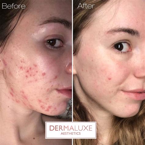 Mollie's Acne Journey : Treating & Managing Hormonal Cystic Acne with DermaLuxe Aesthetics Sheffield