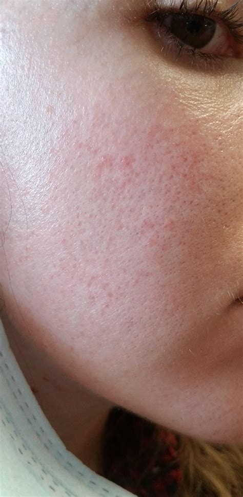 Could this Rash and Other Symptoms be a Result of Dairy Allergy or Intolerance? : r/FoodAllergies