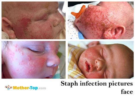 Staph infection and MRSA symptoms in newborns | mother-top.com