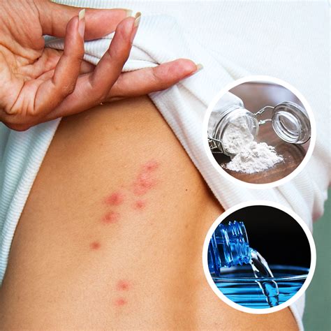 How to Get Rid of Bed Bug Bites– Bed Bug SOS