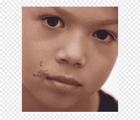 Impetigo Herpes labialis Skin infection Cutaneous condition, dermatome, child, face png | PNGEgg