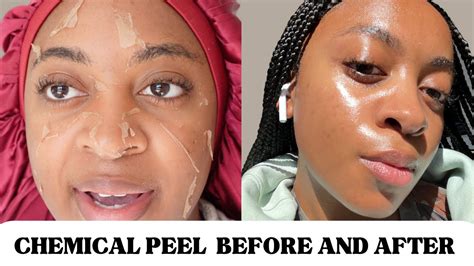 Chemical Peel Before and After Brown Skin: See the Stunning Results!