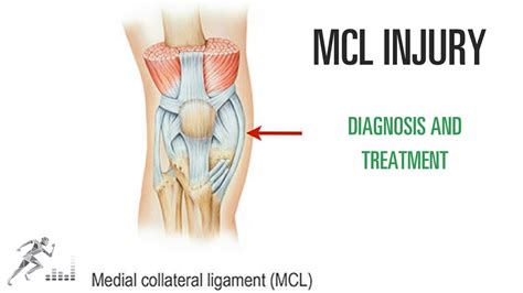 MCL tear of the knee: Injury, diagnosis, treatment - YouTube