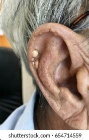 Tophi Helix Ear Patient Had Poor库存照片654714559 | Shutterstock