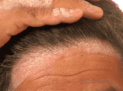 Scalp psoriasis Treatment | Symptoms Causes Treatment and Prevention of Diseases