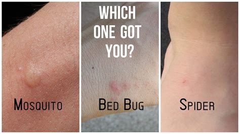 Mosquitoes Bites Vs Bed Bug Bites