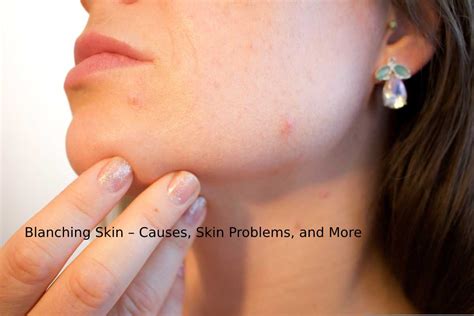 Blanching Skin: Causes, Skin Problems, and More - In Health Blog