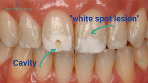 Do You Have a Cavity? Cavities Stages & What They Look Like