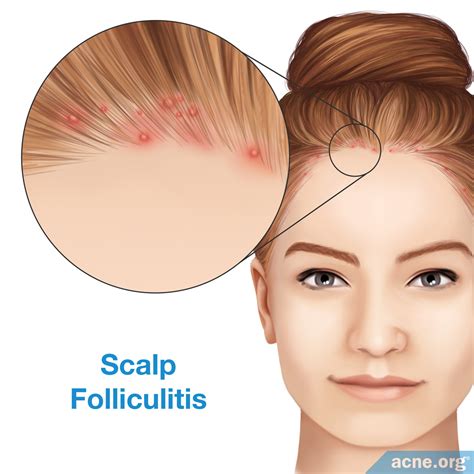 Scalp Acne - Acne.org