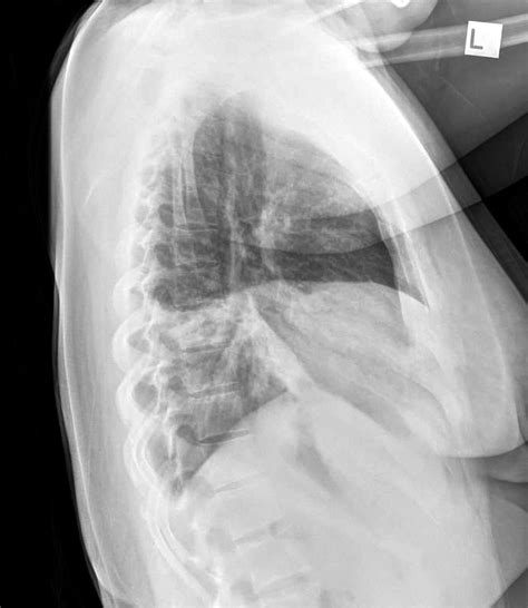 Chest X-Ray Projection | Chest X-Ray - MedSchool