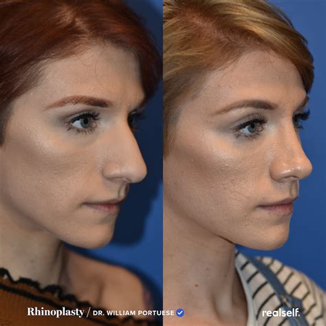 Rhinoplasty nose job in london uk – Artofit