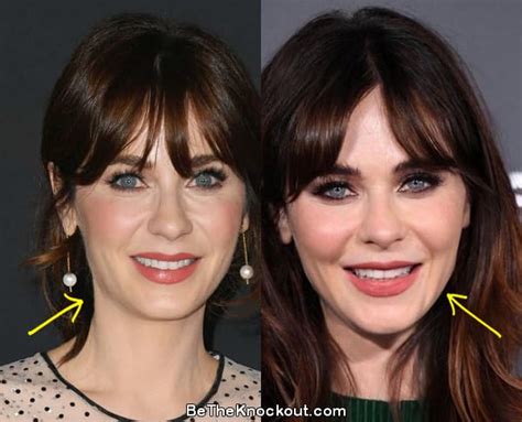 Zooey Deschanel Plastic Surgery Comparison Photos