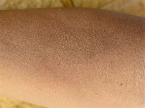 What Is Keratosis Pilaris And What Causes It? – Balmonds