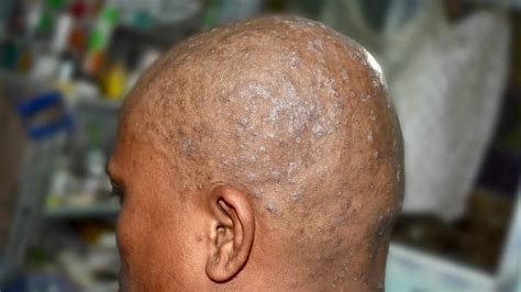 35+ rash on back of head after haircut - Hafidhandris