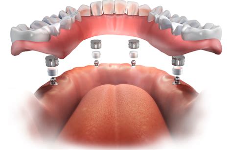 Are Implant-Supported Dentures Removable? | Digital Denture + Implants | Los Angeles, CA