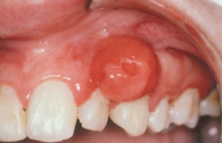 Peripheral Ossifying Fibroma - Dr. Paul Mirdamadi DDS