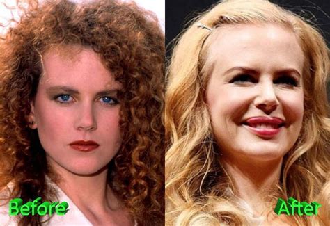 Nicole Kidman plastic surgery | Celebrity Plastic Surgery - #celebrity ...