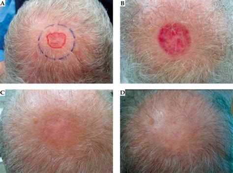 Basal Cell Skin Cancer On Scalp