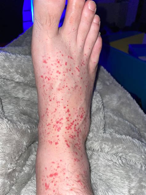 0 Result Images of Why Are There Red Spots On My Legs - PNG Image Collection