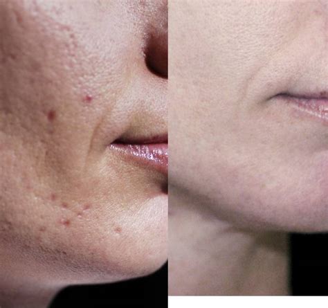 Laser Acne Treatment Cost | Laser Scar Removal Cost