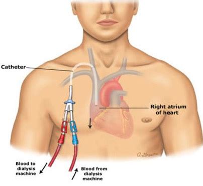 Hemodialysis Tunneled Catheter