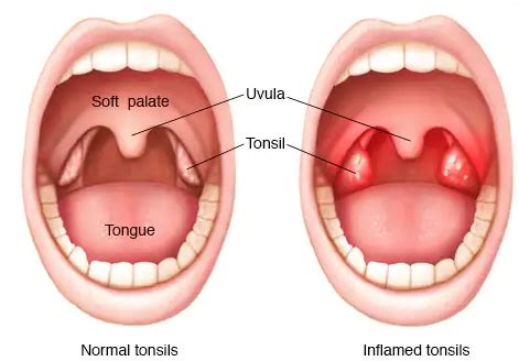 Tonsillitis fact sheet | Emergency Care Institute