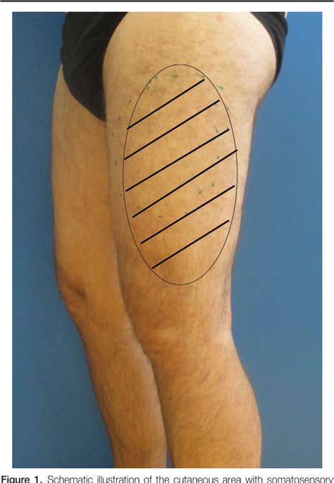 Lateral Femoral Cutaneous Nerve Orthopaedicprinciples - vrogue.co