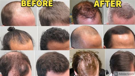 BEFORE/AFTER RESULTS OF FINASTERIDE AND MINOXIDIL USERS FOR TREATING ...