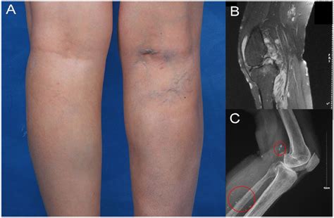 Arteriovenous Malformation Leg