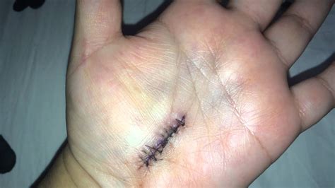 Carpal Tunnel Release Surgery...UPDATE: 1 Week Post Surgery - YouTube