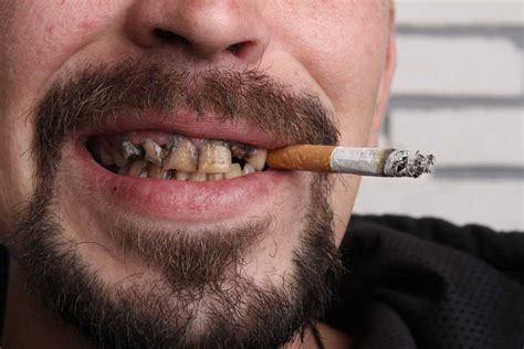 Cigarettes and Teeth: What You Should Know?