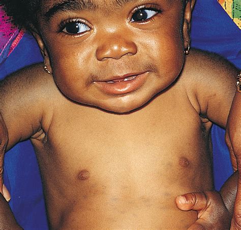 Extensive Mongolian Spots in an Infant With Hurler Syndrome | Dermatology | JAMA Dermatology ...