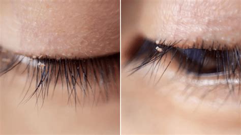 Stomach-churning photos shows eyelashes infested with 'lash lice' as cases are on the rise ...