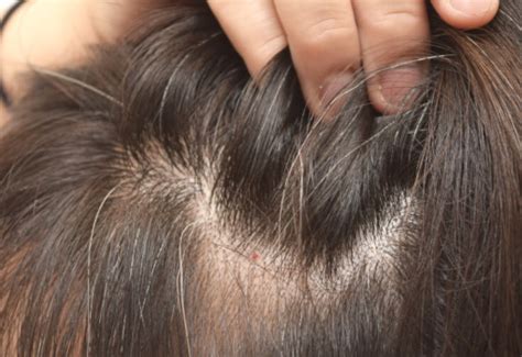 Demodex Hair Tonic Treats Scalp Mite, Hair Loss, Androgenic alopecia, Baldness, Dandruff ...